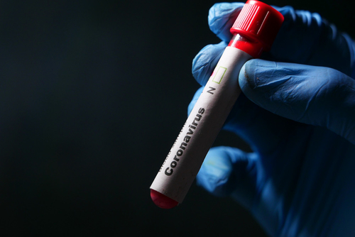 Latest company news about SARS-CoV-2 사이클 역치 : 문제가 되는지 아닌지) 측정